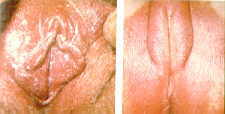 23-10 vulvovaginitis Candida.jpg (4750 bytes)