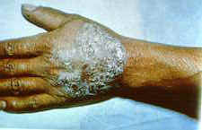 23-16 sporotrichosis.jpg (5859 bytes)