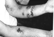 23-17 sporotrichosis.jpg (4207 bytes)