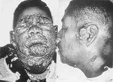 23-19 coccidioidomycosis.jpg (6753 bytes)