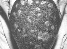23-1 tinea capitis Ttonsurans.jpg (6741 bytes)