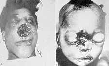 23-21 rhinocerebral mucormycosis.jpg (4778 bytes)