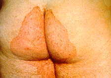 23-3 Epidermophyton or Trichophyton.jpg (5206 bytes)