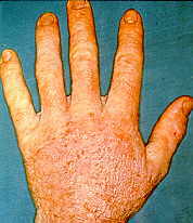 23-5 Trichophyton hand.jpg (7871 bytes)
