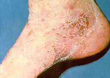 23-6 Trichophyton foot.jpg (5345 bytes)