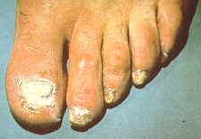 23-7 onychomycosis EorT.jpg (5386 bytes)