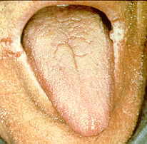 23-8 buccal candidiasis.jpg (7712 bytes)