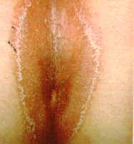 23-9 intertrigo Candida.jpg (4439 bytes)